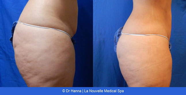 vaser liposuction smartlipo before after photos, Dr. Hanna La Nouvelle Medical Spa, Oxnard, Ventura county female back  