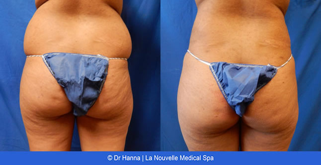 vaser liposuction smartlipo before after photos, Dr. Hanna La Nouvelle Medical Spa, Oxnard, Ventura county female back  